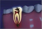 Infection to the pulp chamber of the tooth Tooth Infection