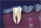 cleaning and shaping the root canal spaces Cleaning the root