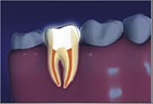 Cleaned root is filled and sealed Root canal filled